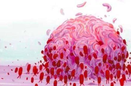 结肠癌的早期5大症状及表现,结肠癌的发展及演变