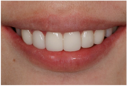 医生如何美白牙齿,牙科医生不把牙彻底补好