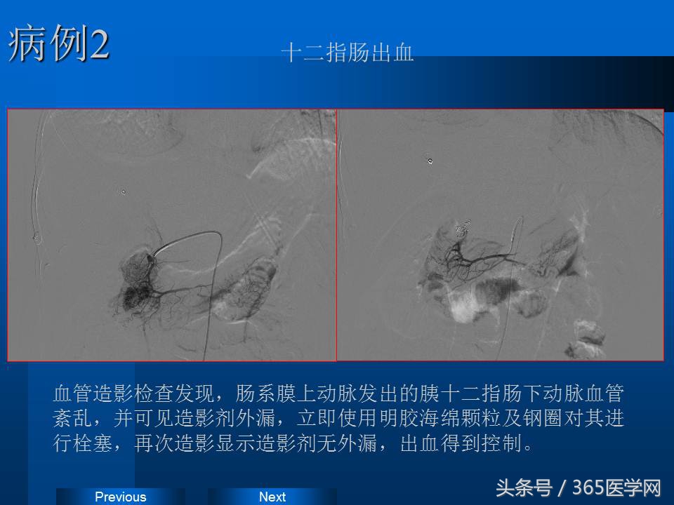 崔进国：消化道出血的介入治疗