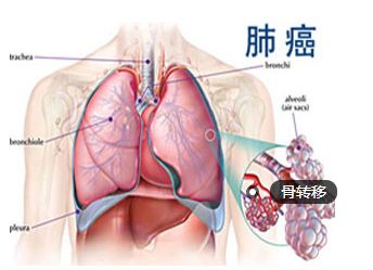 肺癌早期骨转移一般生存期,pd1对肺癌晚期骨转移患者有效吗