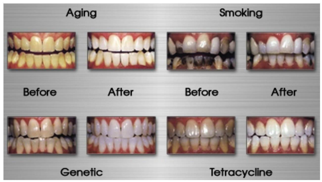 牙越来越黑是什么原因,牙为什么会黄或黑