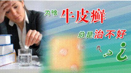 治牛皮癣民间偏方有哪些,生姜洋葱泡白醋治疗牛皮癣的秘方