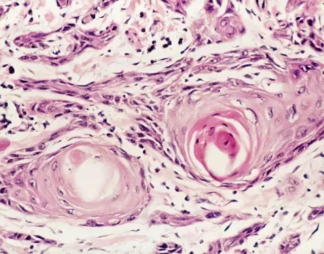 关于舌癌的新闻又一次刷屏,我想起了一年前离开的那位老人