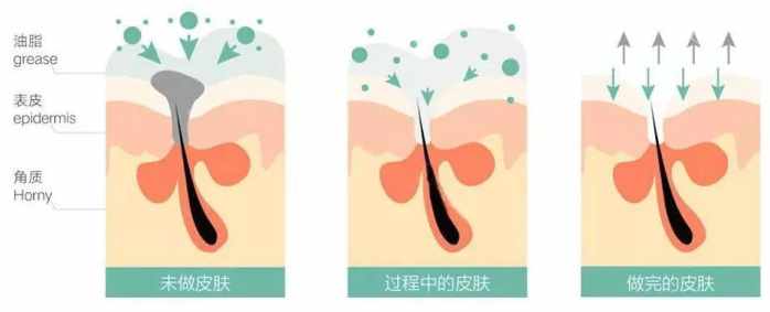 天津美莱超微小气泡洁净毛孔排毒嫩肤