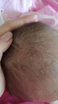 新手妈妈来围观:新生儿“胎毒”“胎垢”和胎脂到底该不该清除?