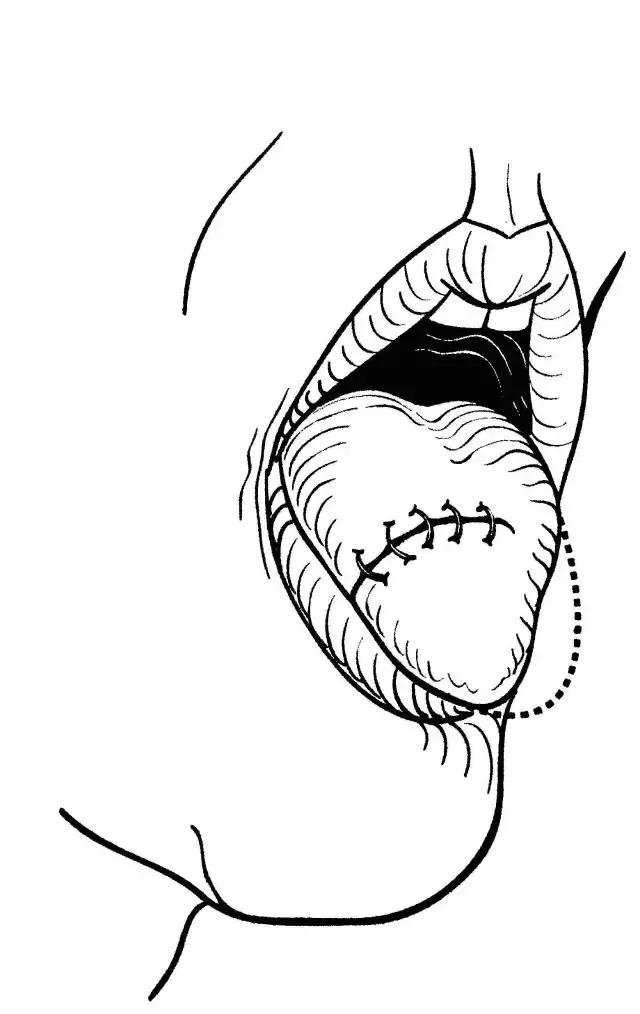 关于舌癌的新闻又一次刷屏,我想起了一年前离开的那位老人