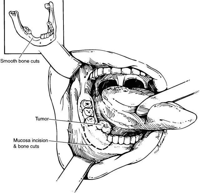 关于舌癌的新闻又一次刷屏,我想起了一年前离开的那位老人