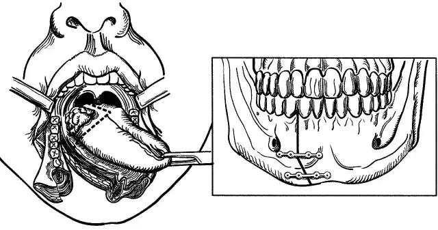 关于舌癌的新闻又一次刷屏,我想起了一年前离开的那位老人
