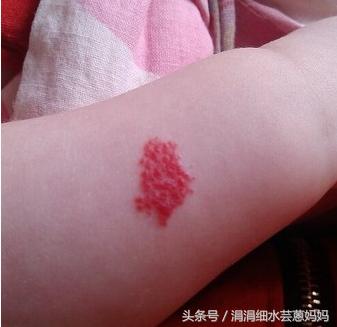 小孩胳膊有黑白花斑,小孩有一块血斑