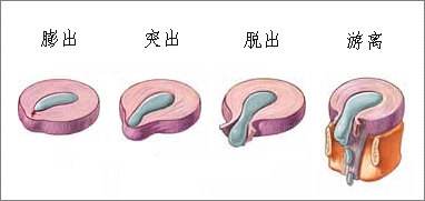 腰椎间盘突出最严重后果,骨质增生腰椎间盘突出要注意什么