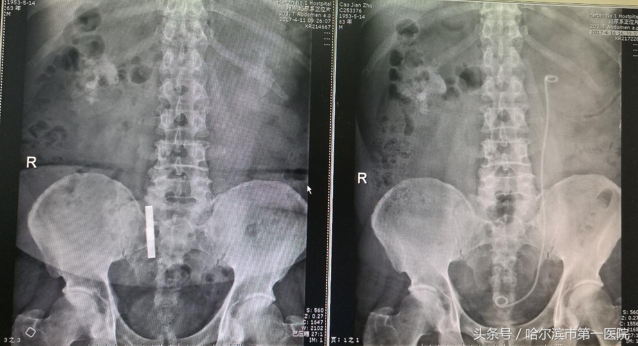 结石像鹿角占满左肾 哈市一院泌外专家半小时成功取出