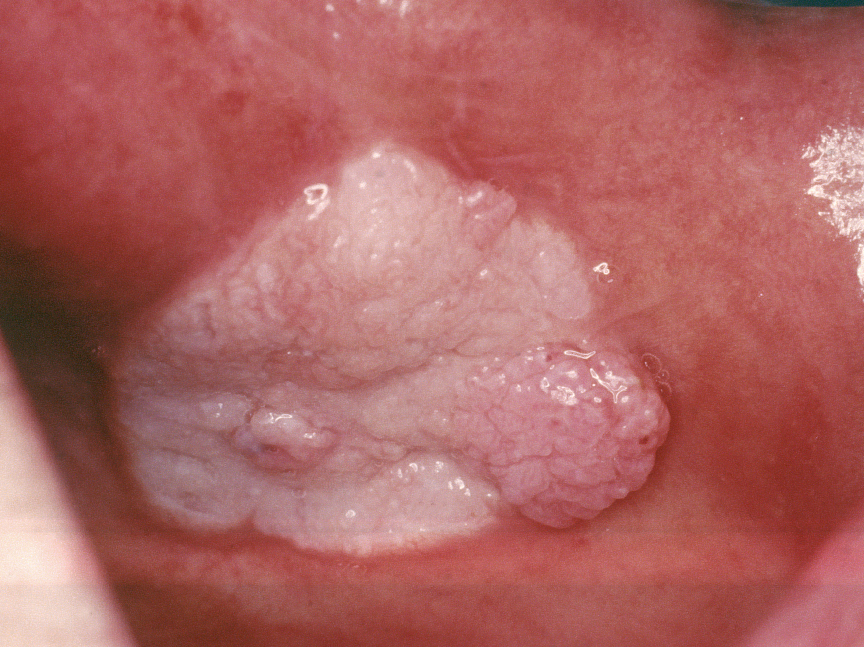 关于舌癌的新闻又一次刷屏,我想起了一年前离开的那位老人