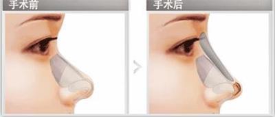 一招解决塌鼻子,专治塌鼻子方法