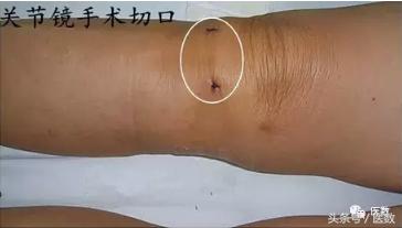 膝盖积水什么颜色,病就是什么样的