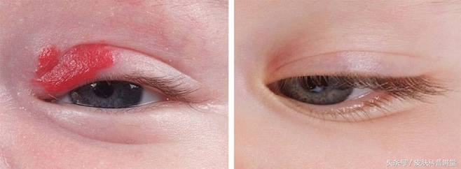 普萘洛尔治疗婴幼儿血管瘤的原因,普萘洛尔治疗血管瘤的注意事项