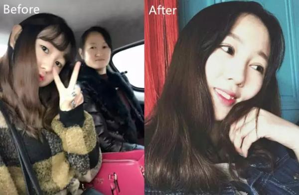 割双眼皮肉条感怎么修复消除,割双眼皮三个月了还有肉条怎么办