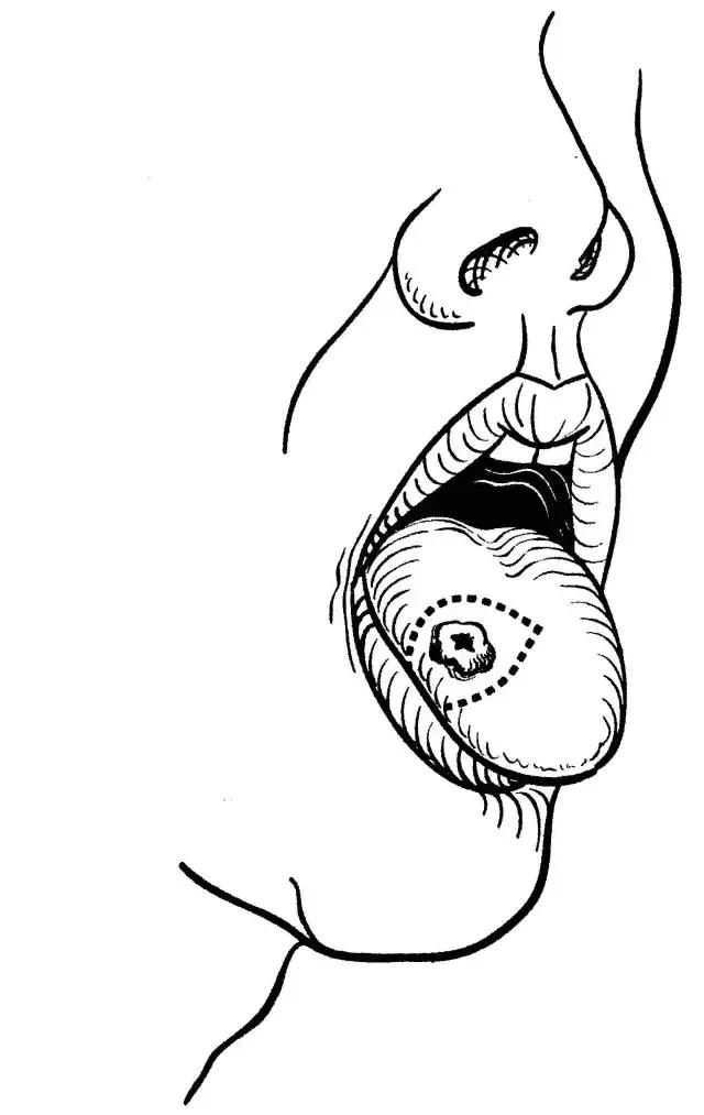 关于舌癌的新闻又一次刷屏,我想起了一年前离开的那位老人