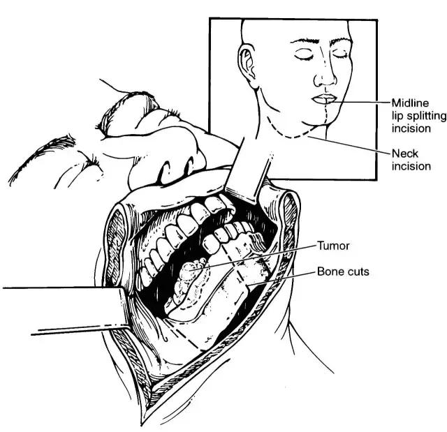 关于舌癌的新闻又一次刷屏,我想起了一年前离开的那位老人