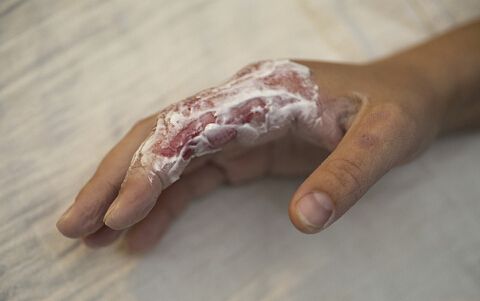 烧伤补液案例分析,烧伤用的修复液