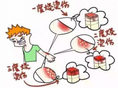 烧伤补液案例分析,烧伤用的修复液