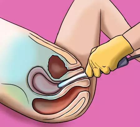 妇科体检一般建议检哪几种,妇科体检怎么选医院