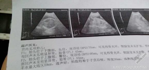 我的高龄试管历程,47岁大龄试管成功
