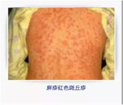 麻疹高发期在什么季节,麻疹的防治知识