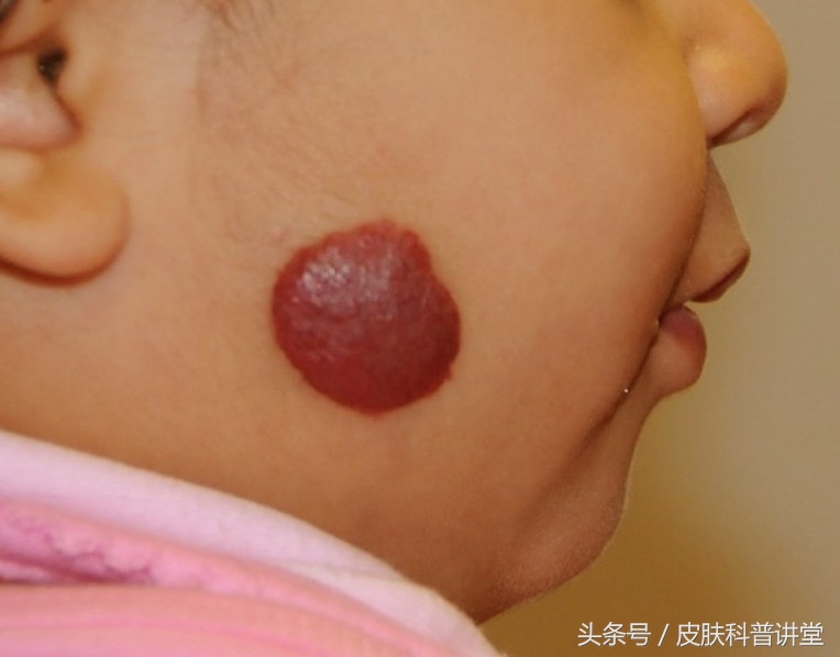 普萘洛尔治疗婴幼儿血管瘤的原因,普萘洛尔治疗血管瘤的注意事项