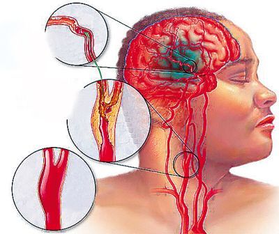 颈动脉斑块会引起脑中风吗,天生右颈动脉狭窄会导致脑中风吗