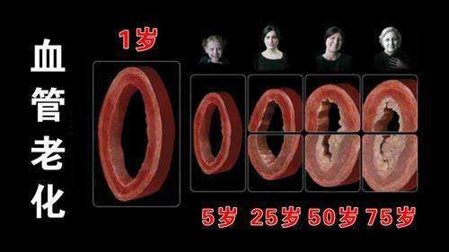 颈动脉斑块会引起脑中风吗,天生右颈动脉狭窄会导致脑中风吗