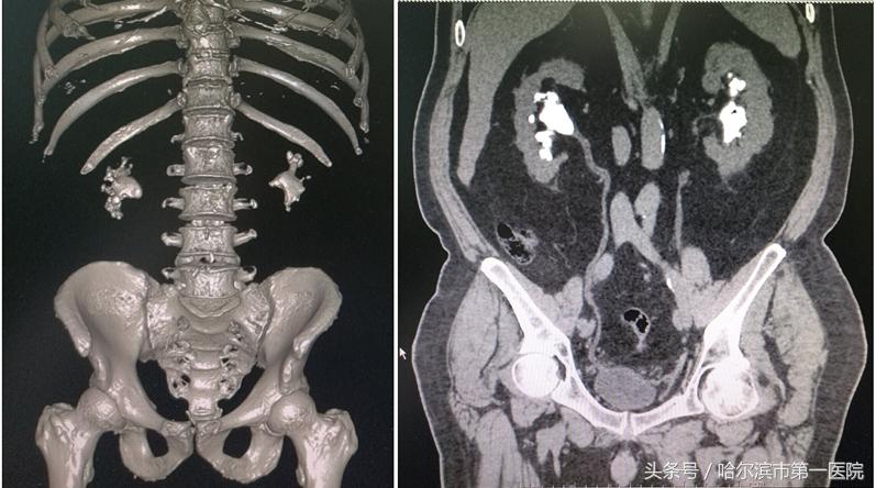 结石像鹿角占满左肾 哈市一院泌外专家半小时成功取出