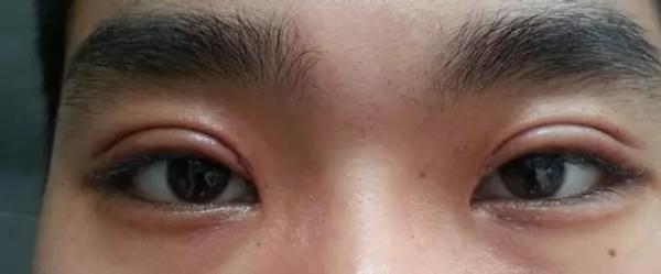 割双眼皮肉条感怎么修复消除,割双眼皮三个月了还有肉条怎么办