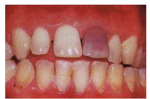 牙越来越黑是什么原因,牙为什么会黄或黑