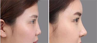 一招解决塌鼻子,专治塌鼻子方法