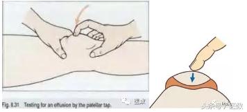 膝盖积水什么颜色,病就是什么样的