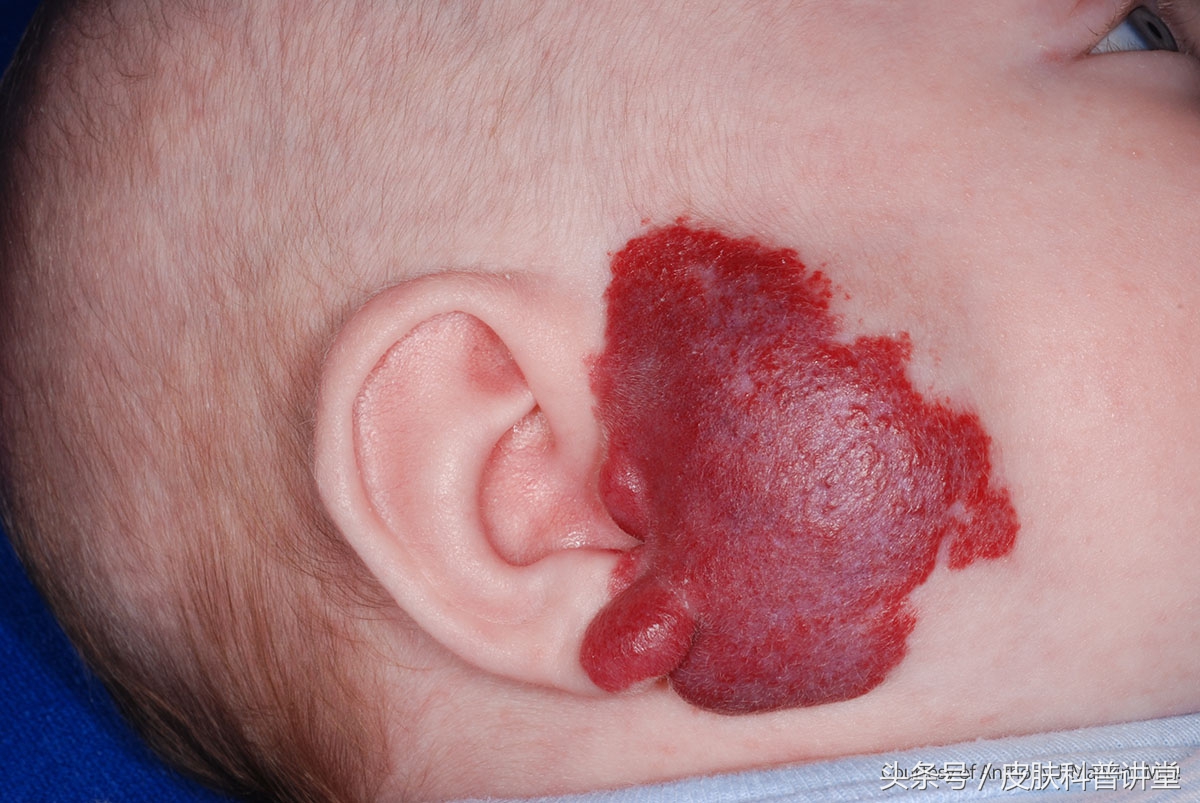 普萘洛尔治疗婴幼儿血管瘤的原因,普萘洛尔治疗血管瘤的注意事项