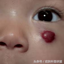 普萘洛尔治疗婴幼儿血管瘤的原因,普萘洛尔治疗血管瘤的注意事项