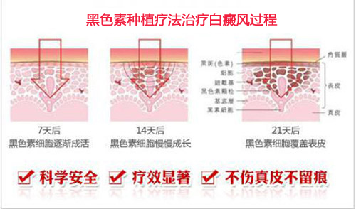 治好白癜风要花多少钱,白癜风治疗要花多少钱合适