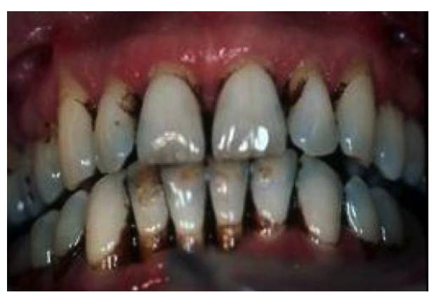 牙越来越黑是什么原因,牙为什么会黄或黑