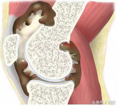 膝盖积水什么颜色,病就是什么样的