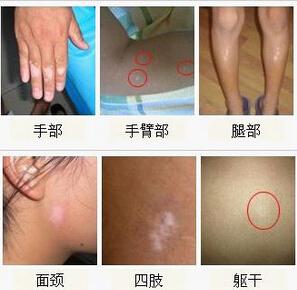 治好白癜风要花多少钱,白癜风治疗要花多少钱合适