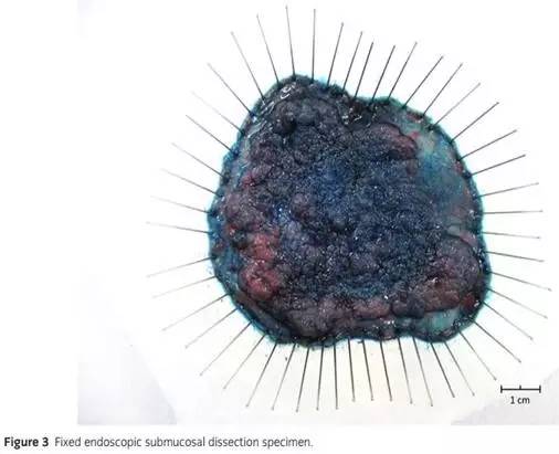 日本消化器内视镜学会结直肠ESD/EMR指南2015版(下)