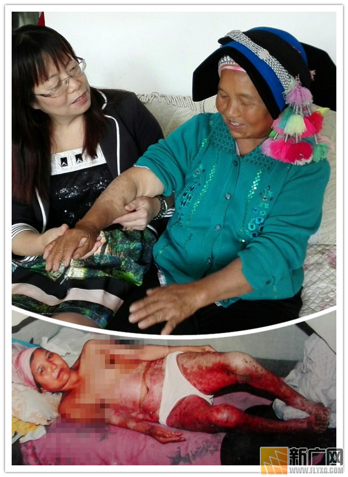 彝族村民李增贵烤贾酒盼脱贫遇火灾,栽多少包谷才能抚平49%烧伤