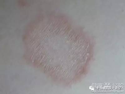 玫瑰糠疹的危害性,玫瑰糠疹有什么危害