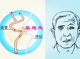 左眼皮跳一般都是发生不好的事,左眼皮跳在家有什么办法治疗吗