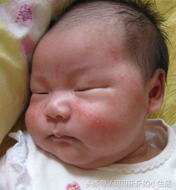 慢性湿疹会终生不愈吗,婴儿湿疹怎么办三个妙招来解决