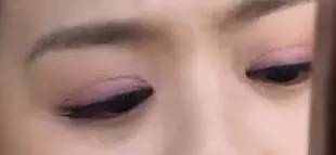 双眼皮手术该如何避免长期疤痕肉条不消肿?