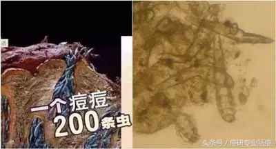 长痘上密密麻麻的虫子是什么,痘痘里面的虫子是什么