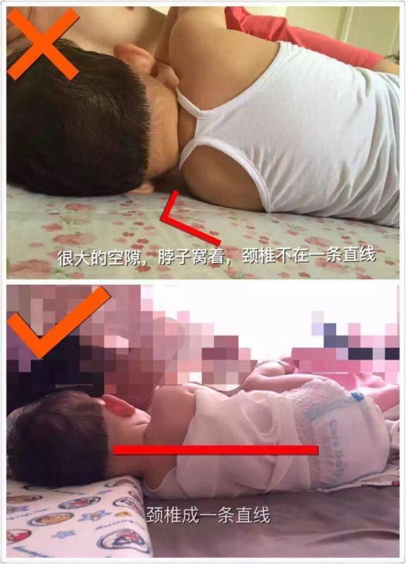 孩子驼背怎么才是最好的治疗,小孩驼背有什么好方法纠正