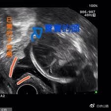 23周宝宝，脚已经掉出来，还能塞回去安胎吗？
